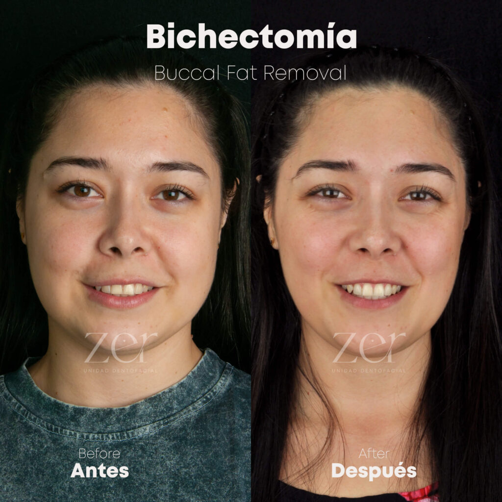 Bichectomía Antes y Después
