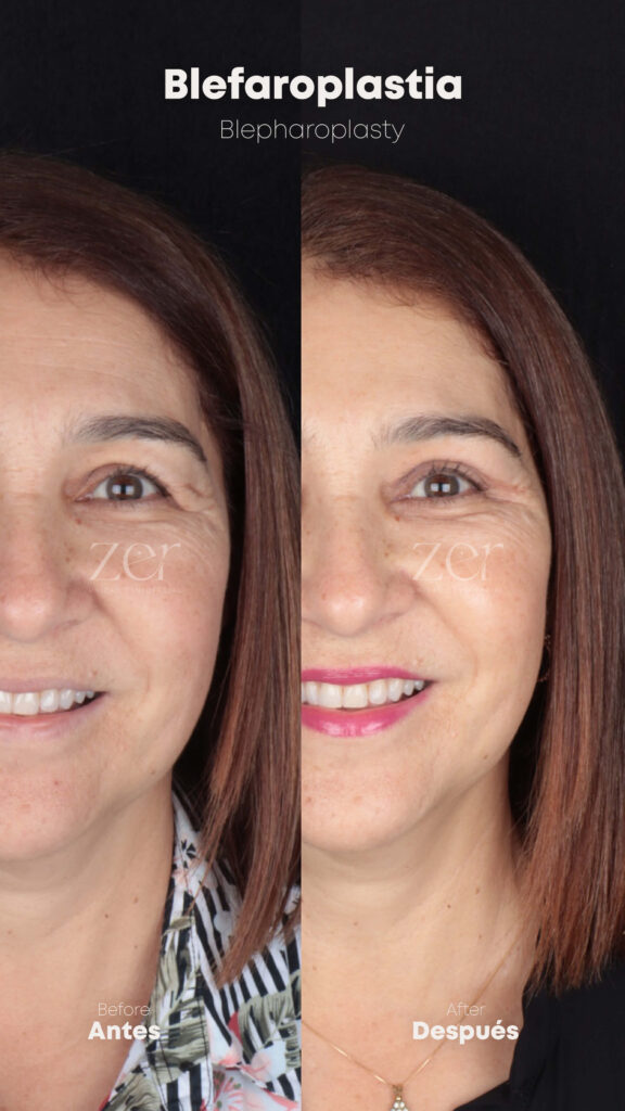 Blefaroplastia Antes y Después