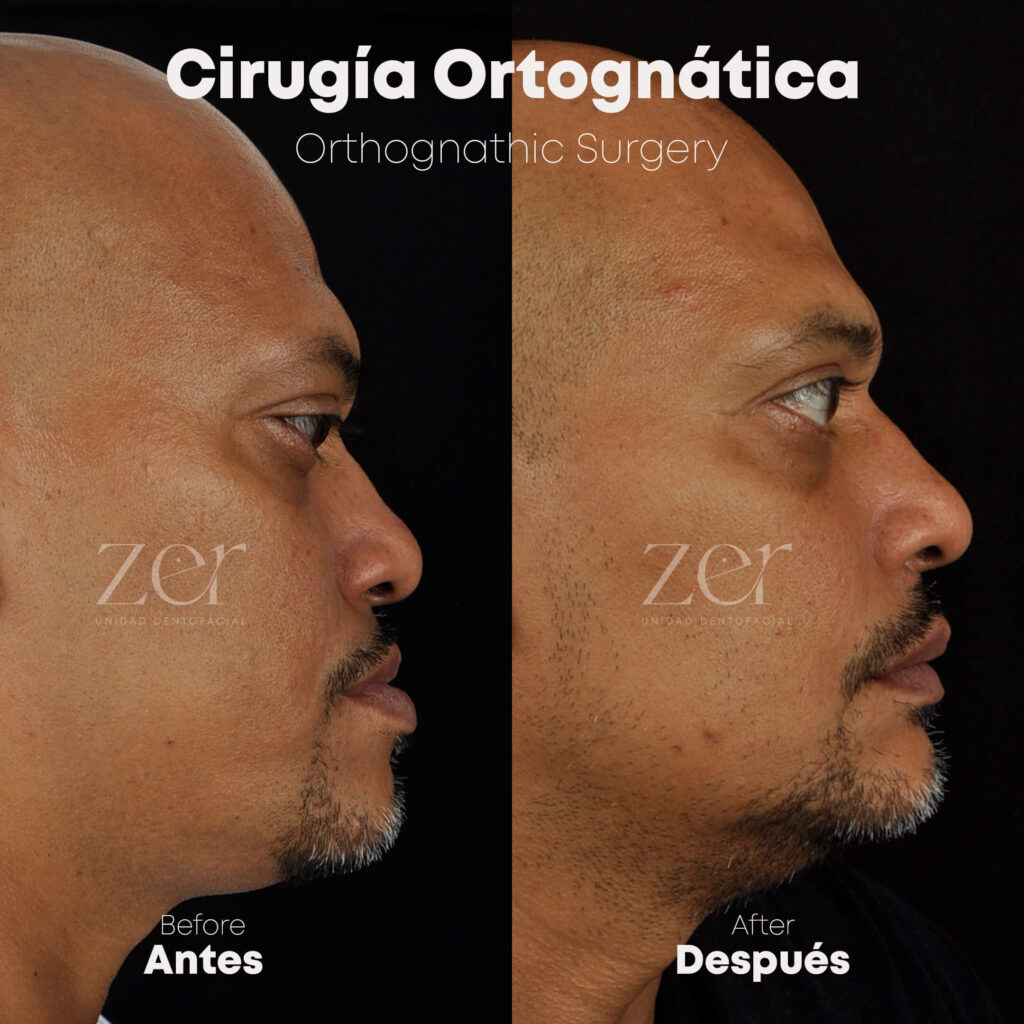 Cirugía Ortognática Antes y Después
