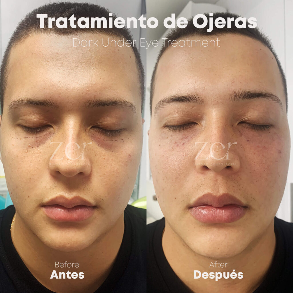 Tratamiento de Ojeras Antes y Después